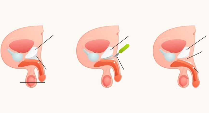 ligamentotomia w celu powiększenia penisa